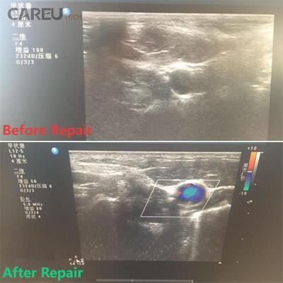 Sonde à ultrasons L12-5 pour réparation